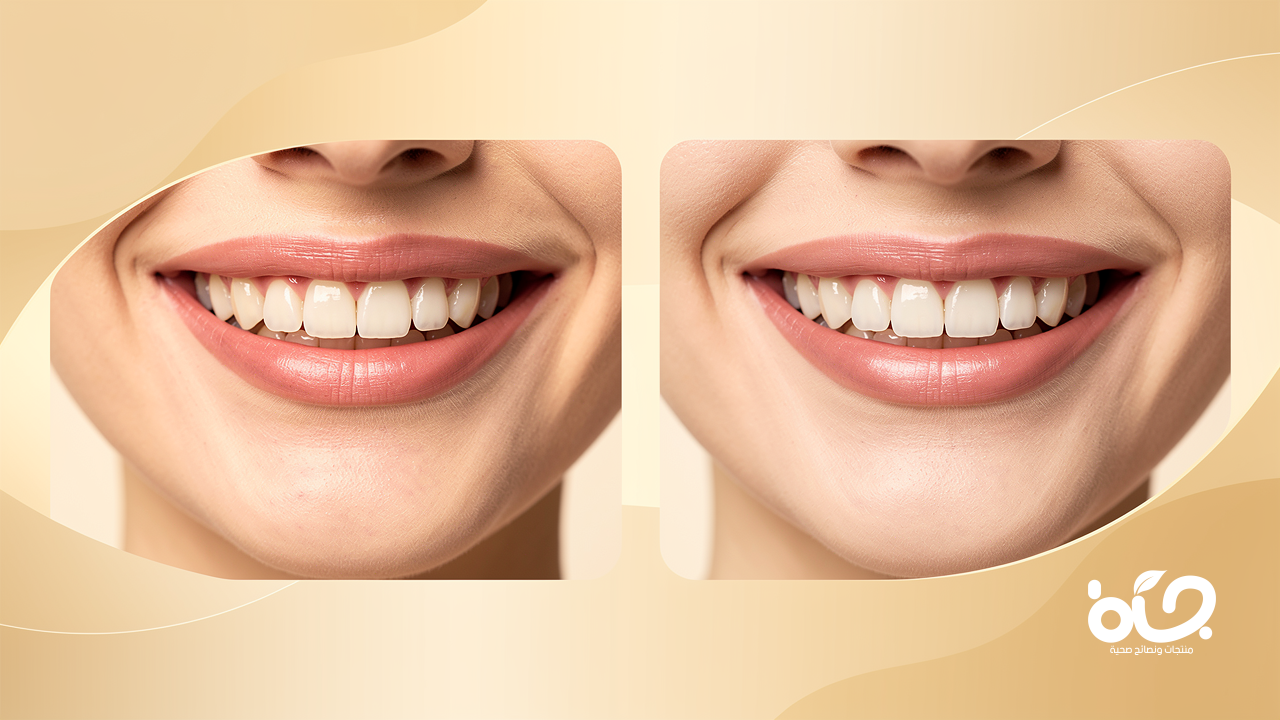 تجميل الابتسامة اللثوية: حلول فعالة لجاذبية مثالية